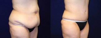 Right 3/4 View - Circumferential Tummy Tuck