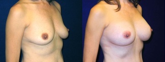 Right 3/4 View - Breast Augmentation After Pregnancy