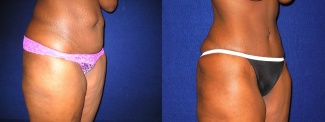 Right 3/4 View - Tummy Tuck After Pregnancy