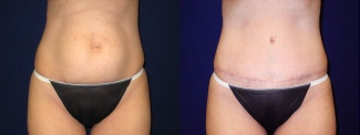 Frontal View - Tummy Tuck After Pregnancy