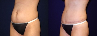 Left 3/4 View - Tummy Tuck After Pregnancy