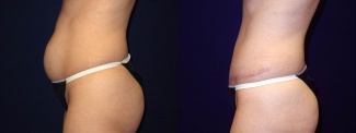 Left Profile View - Tummy Tuck After Pregnancy