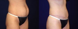 Right 3/4 View - Tummy Tuck After Pregnancy