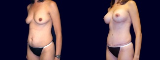 Left 3/4 View - Breast Augmentation and Tummy Tuck After Pregnancy