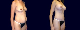 Right 3/4 View - Breast Augmentation and Tummy Tuck After Pregnancy