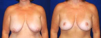 Frontal View - Breast Lift