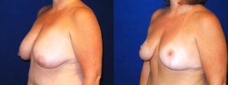 Left 3/4 View - Breast Lift