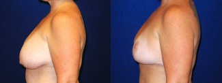 Left Profile View - Breast Lift