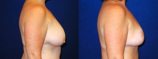 Right Profile View - Breast Lift