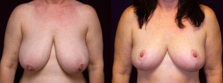 Frontal View - Breast Reduction After Pregnancy