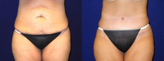 Frontal View - Tummy Tuck After Pregnancy