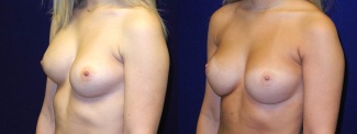 Left 3/4 View - Breast Implant Revision - Silicone Implants