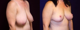 Right 3/4 View - Breast Reduction After Pregnancy