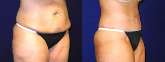 Right 3/4 View - Tummy Tuck After Pregnancy