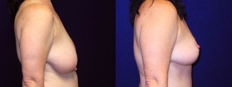 Right Profile View - Breast Reduction After Pregnancy