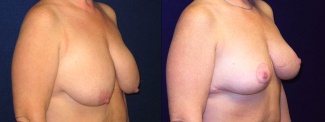 Right 3/4 View - Breast Lift After Pregnancy & Weight Loss