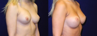 Right 3/4 View - Breast Implant Revision - Silicone Implants