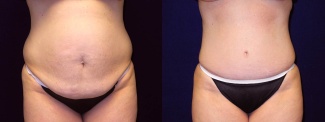 Frontal View - Tummy Tuck After Pregnancy