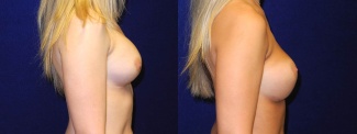 Right Profile View - Breast Implant Revision