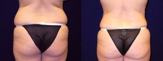 Posterior View - Tummy Tuck After Pregnancy