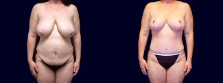 Frontal View - Breast Reduction and Tummy Tuck After Pregnancy