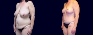 Left 3/4 View - Breast Reduction and Tummy Tuck After Pregnancy