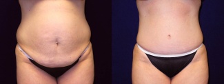 Frontal View - Tummy Tuck After Pregnancy