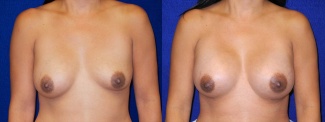 Frontal View - Breast Implant Revision - Silicone Implants