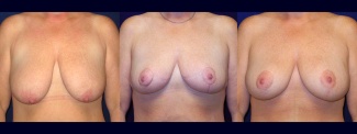 Frontal View - Breast Augmentation with Lift - Silicone Implants