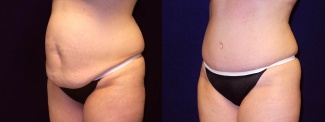 Left 3/4 View - Tummy Tuck After Pregnancy