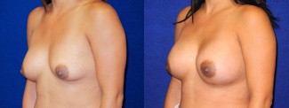 Right 3/4 View - Breast Implant Revision - Silicone Implants