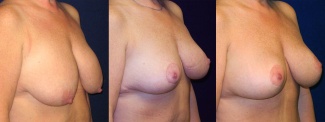 Right 3/4 View - Breast Augmentation with Lift - Silicone Implants