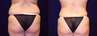 Posterior View - Tummy Tuck After Pregnancy