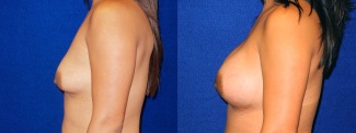 Right Profile View - Breast Implant Revision - Silicone Implants