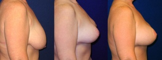 Right Profile View - Breast Augmentation with Lift - Silicone Implants