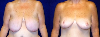 Frontal View - Breast Reduction After Weight Loss