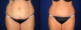 Frontal View - Tummy Tuck and Liposuction