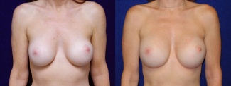 Frontal View - Breast Implant Revision - Silicone Implants