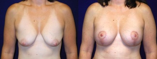 Frontal View - Breast Augmentation with Lift After Pregnancy