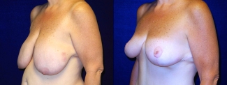 Left 3/4 View - Breast Reduction After Weight Loss