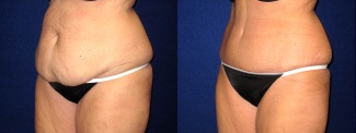 Left 3/4 View - Tummy Tuck and Liposuction