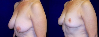 Left 3/4 View - Breast Lift