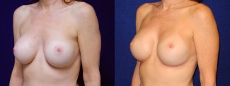 Left 3/4 View - Breast Implant Revision - Silicone Implants