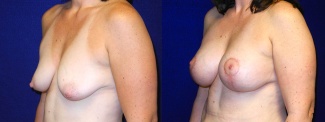 Left 3/4 View - Breast Augmentation with Lift After Pregnancy