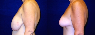 Left Profile View - Breast Reduction After Weight Loss