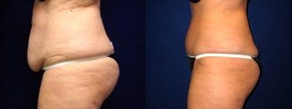 Left Profile View - Tummy Tuck and Liposuction