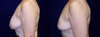 Left Profile View - Breast Lift