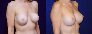 Right 3/4 View - Breast Implant Revision - Silicone Implants