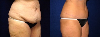 Right 3/4 View - Tummy Tuck and Liposuction