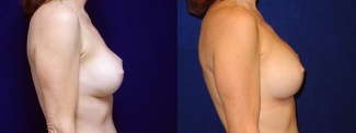 Right Profile View - Breast Implant Revision - Silicone Implants